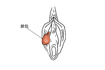 妇科脓包图片大全