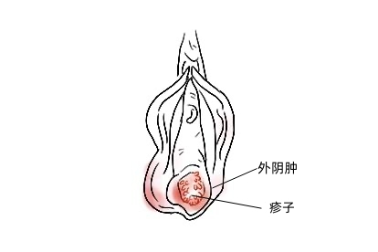 女性外阴肿珍珠图